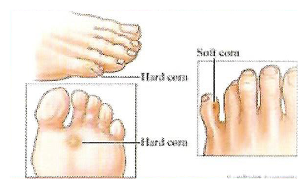 Foot Problems | Feet Problems | Foot Conditions